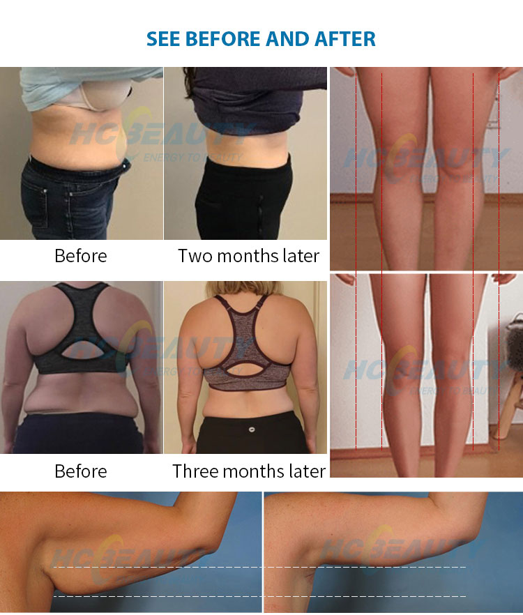 Sharper Image Fat Freezer Chin And Neck Sculpting System Sharper Image Fat Freezer Chin And Neck Sculpting System