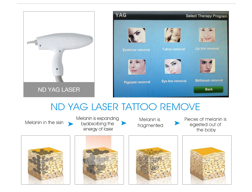 3 in 1 Nd Yag Laser Rf E Light Hair Removal Machine Price BM11S (4)