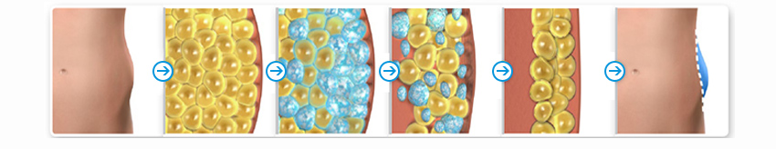 Professional Cryo Fat Freeze Machine Slimming Loss Weight ETG15-4 .jpg