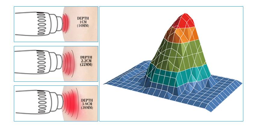 Home Use Ed Shockwave Physiotherapy Machine