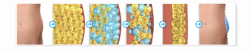Freezefat machine principle