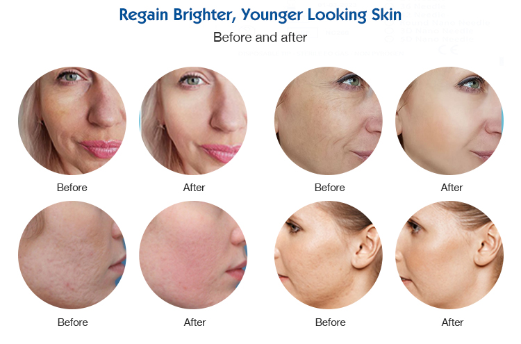 Meso Gun Skin Rejuvenation Wrinkle Removal Face Care 