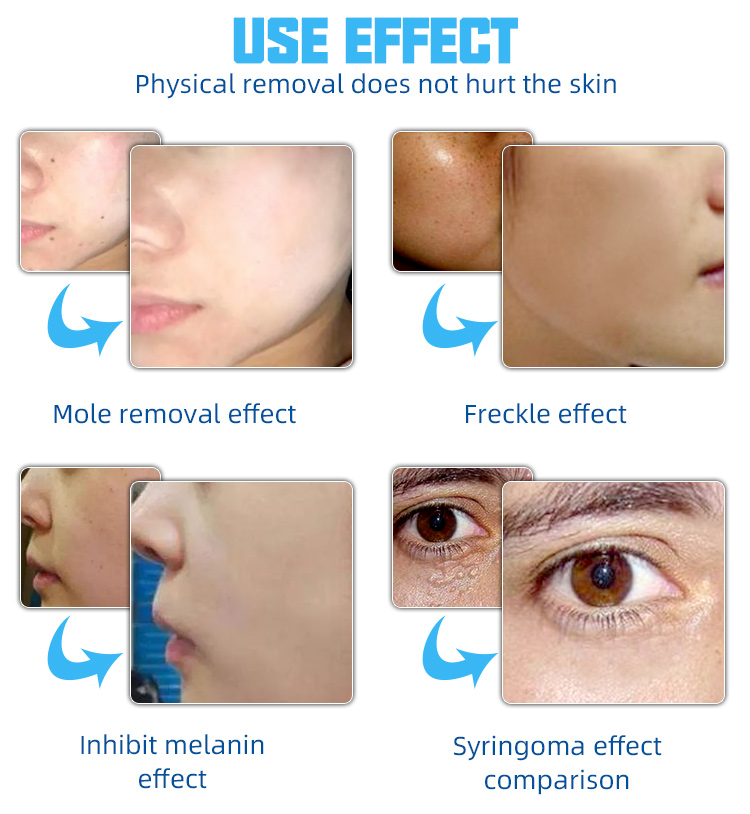 Beauty Instrument Ozone 2 in 1 Plasma Point Pen for Eye Lifting Laser Wrinkle Mole Removal Pen