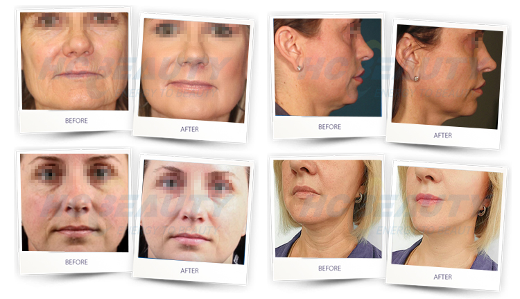 LED High Quality Wrinkle Removal Skin Lift Rf Face Massager