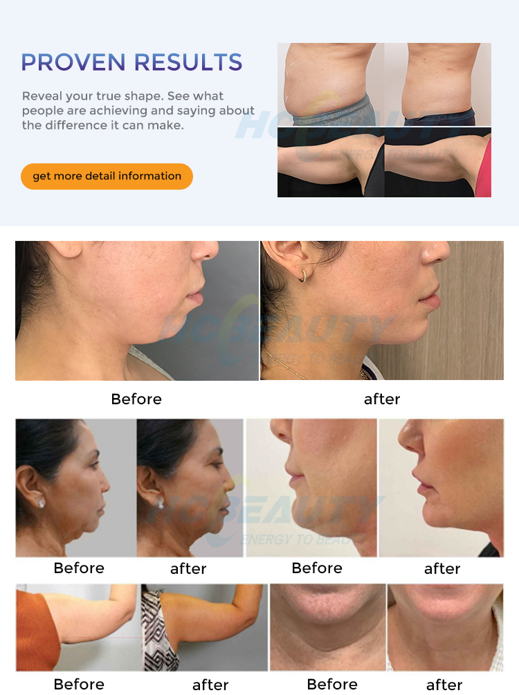 trusculpt id machine for sale