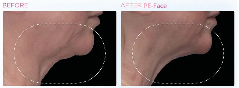 Skin Tightening Rf Muscle Stimulator Face Machine