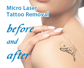 Pico laser tattoo removal before and after 
