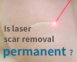 Is laser scar removal permanent?