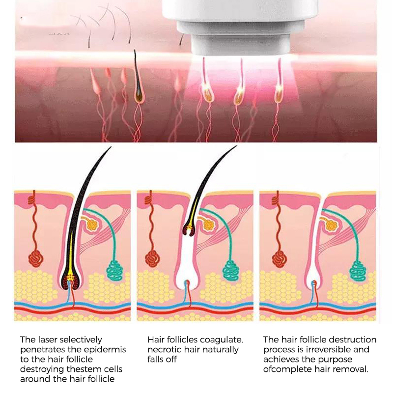 best laser hair removal machines professional