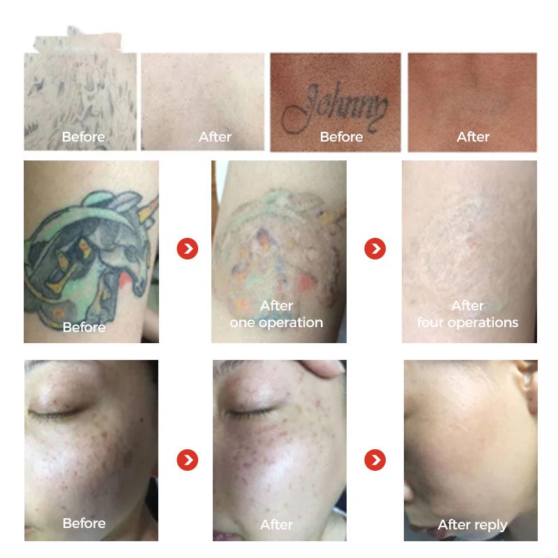 New Laser Tattoo Removal Skin Whitening Device BM25