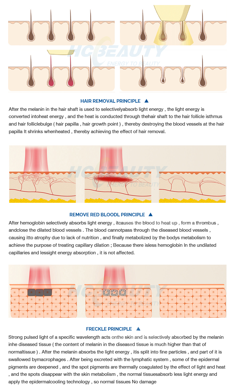 Clinic Use Vertical Opt Shr Ipl Machine Hair Removal Skin Treatment With 2 Handles 