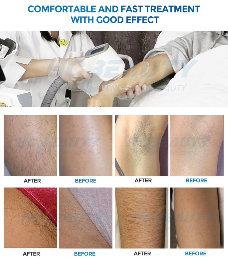 Laser Hair Removal Machine Price in Lebanon 3 Wavelength Permanent Result