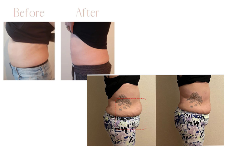 rf body sculpting before and after