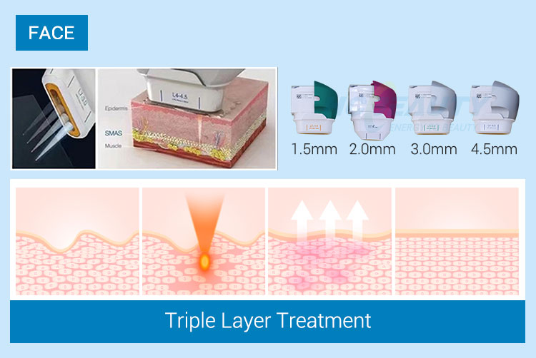 Smas Lifting High Intensity Focused Ultrasound Facial 7d Hifu Machine 