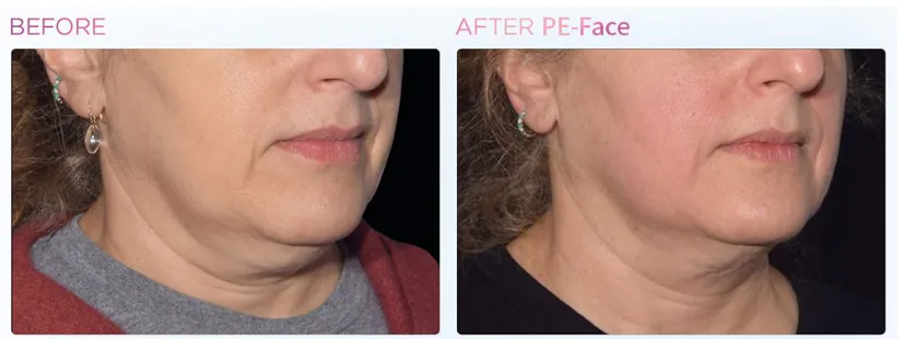 Skin Tightening Rf Muscle Stimulator Face Machine