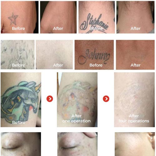 Decoding Tattoo Removal Lasers: Q-Switched vs. Picosecond Showdown