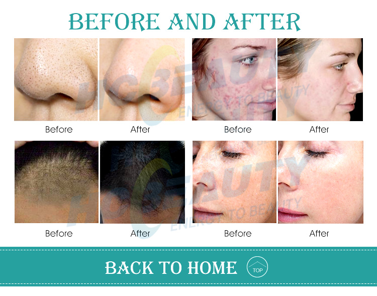 PDT Led Facial Light/phototherapy Skin Care/led Pdt Bio-light Therapy Beauty Machine Therapy with Led Light