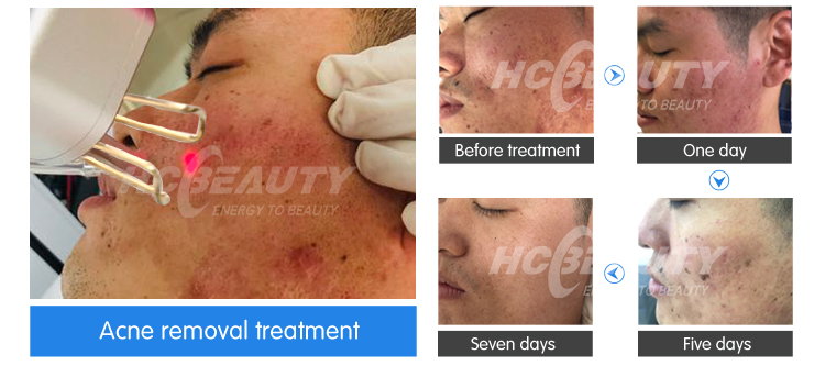 New Arrival Professional Clinic 60W Co2 Laser Fractional Machine Price