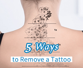 5 Types of Tattoo Removal Methods (Some to Stay Away From!)