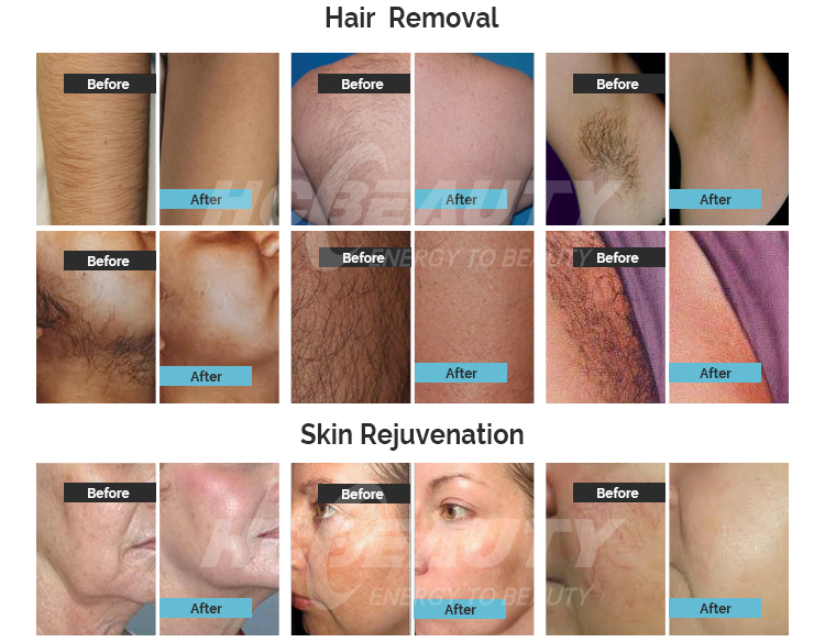 Professional E-light Shr Ipl for Skin And Hair Removal