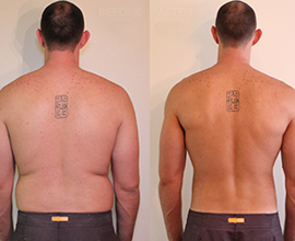 Understanding The Difference of Body Sculpting vs Liposuction