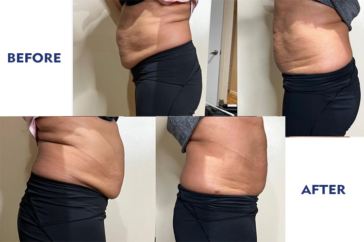 rf body sculpting before and after