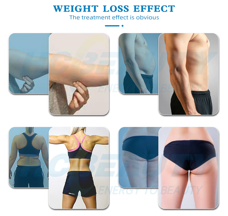 Professional 360 Degrees Cryolipolysis Machine