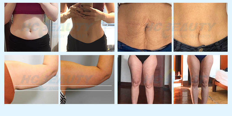 Smas Lifting High Intensity Focused Ultrasound Facial 7d Hifu Machine 