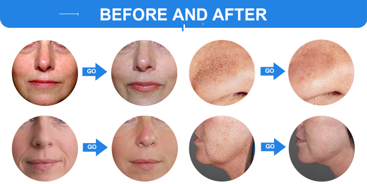 Diamond Glow Facial Machine treatment