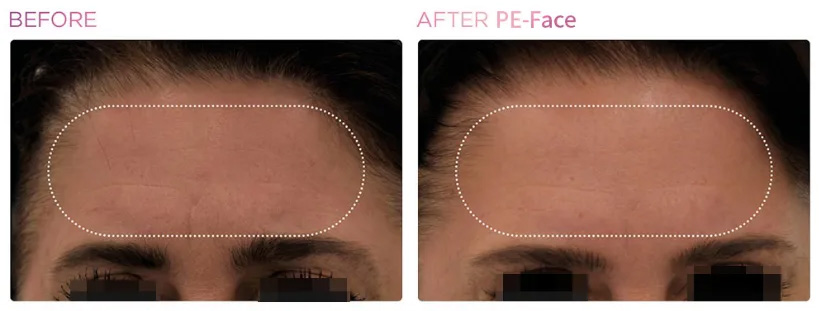 Skin Tightening Rf Muscle Stimulator Face Machine