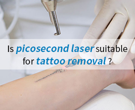 Is Pico laser good for tattoo removal