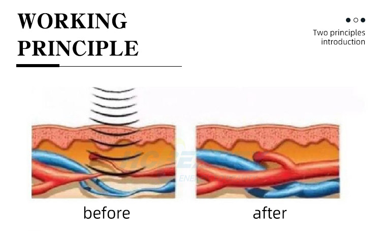 Fast Recovery Shock Therapy for Back Pain