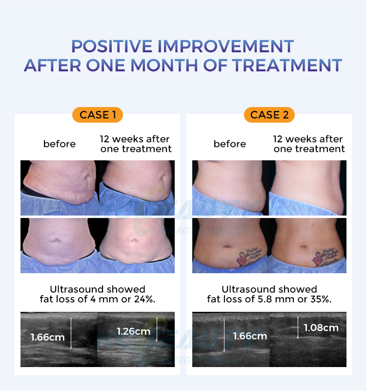 trusculpt id machine for sale