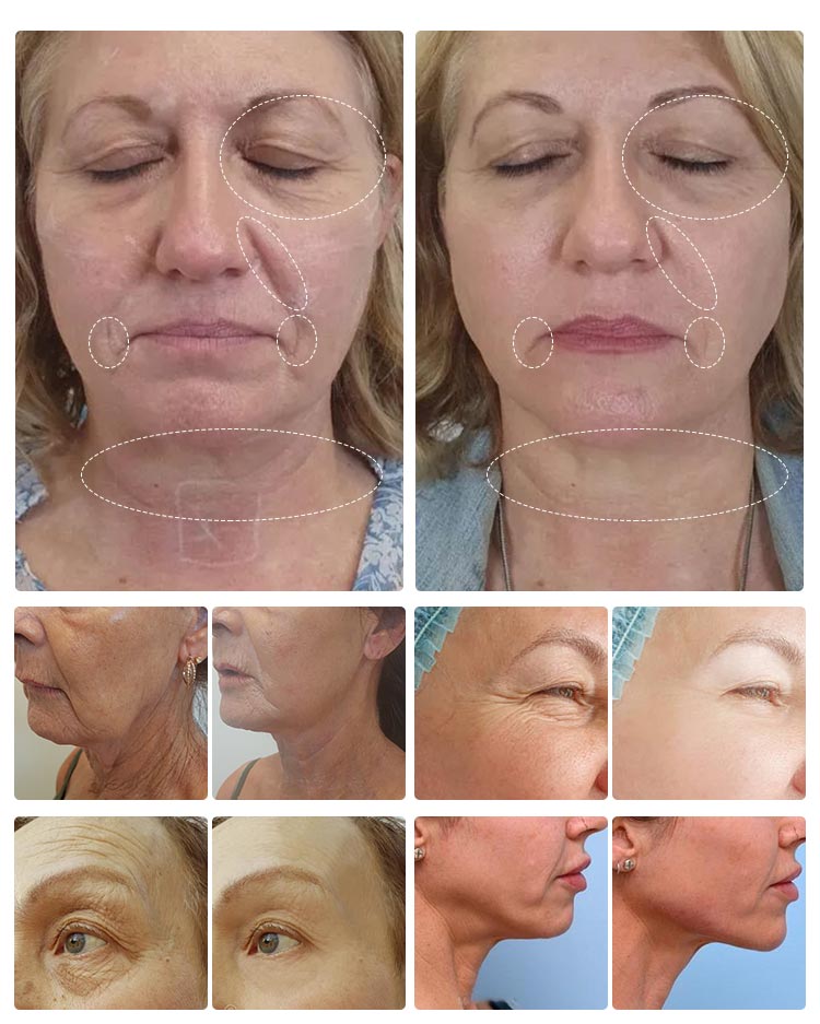 Medical Spa High Intensity Focus Ultrasound 7d Hifu Machine 