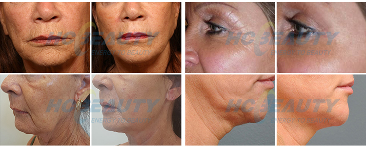 2021 New Technology Portable 7d Hifu Ultramage Hifu