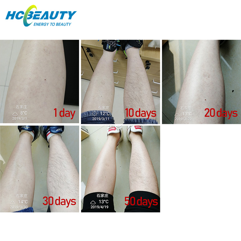 Beauty Equipment Laser 808/ 755nm 808nm 1064nm Depilazion 3 Wavelength Diode Laser System 