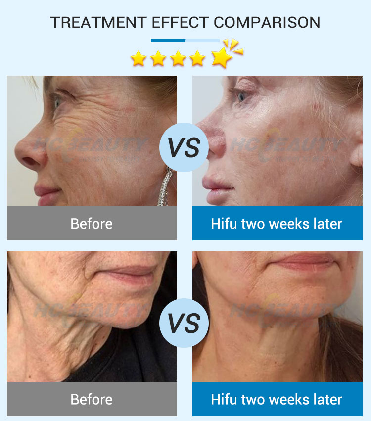 Smas Lifting High Intensity Focused Ultrasound Facial 7d Hifu Machine 