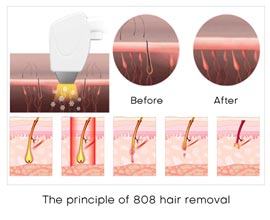 laser-hair-removal.jpg