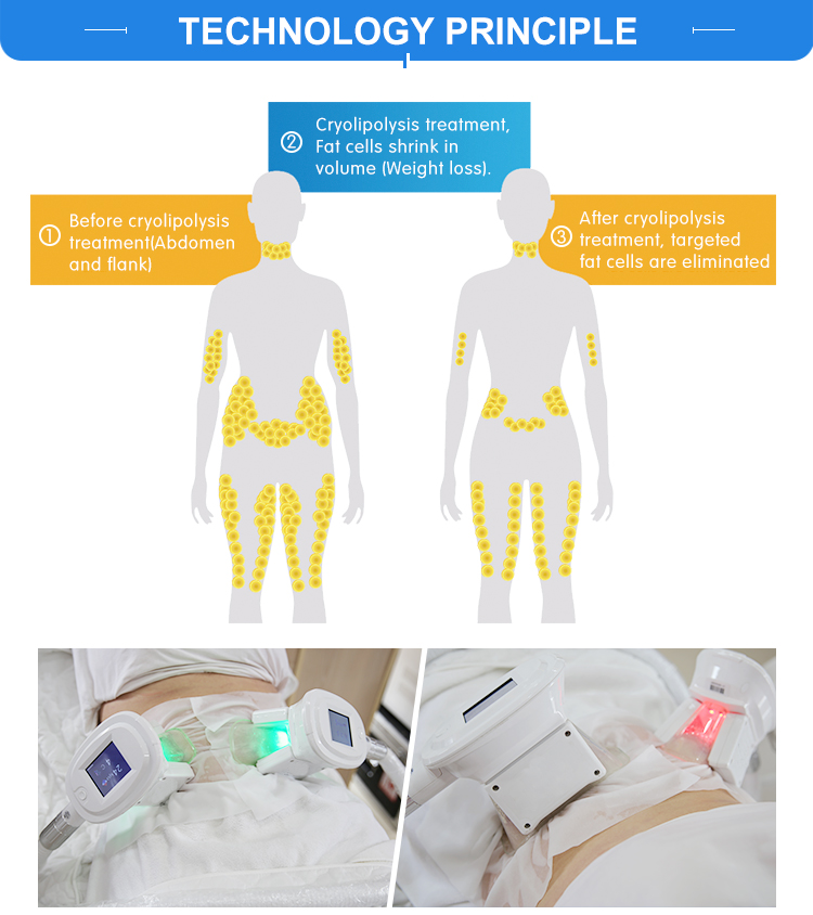 Double Chin Weight Loss Cryolipolysis Slimming Machine for Fat Freezing