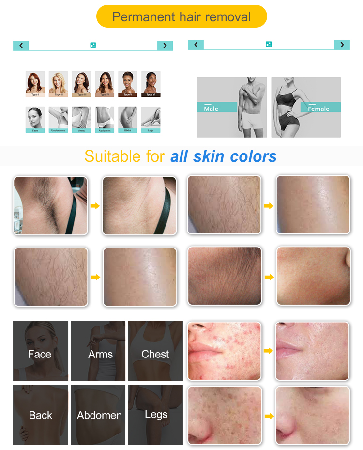 Портативный Лазерный Стиль 532nm 1064nm Стоимость Татуировки Для Удаления Машины