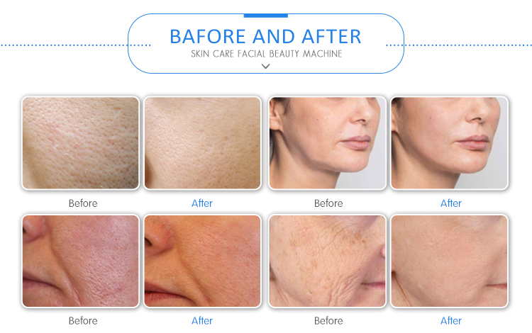 Portable Small Spa Oxygen Faical Deep Cleaning Wholesale Skin Care Instrument