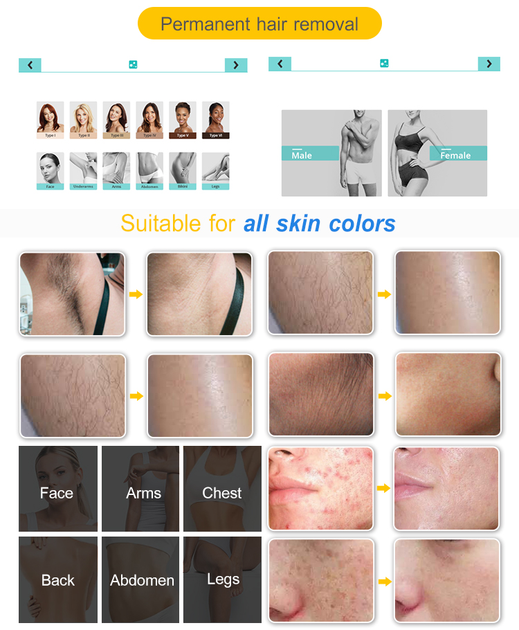 Diode Laser Hair Removal From South Korea