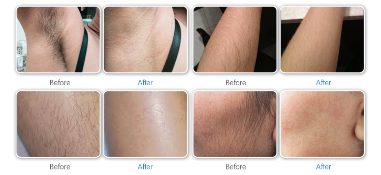 Desktop 3 Wavelengths Diode Laser Machine for Hair Removal BM15