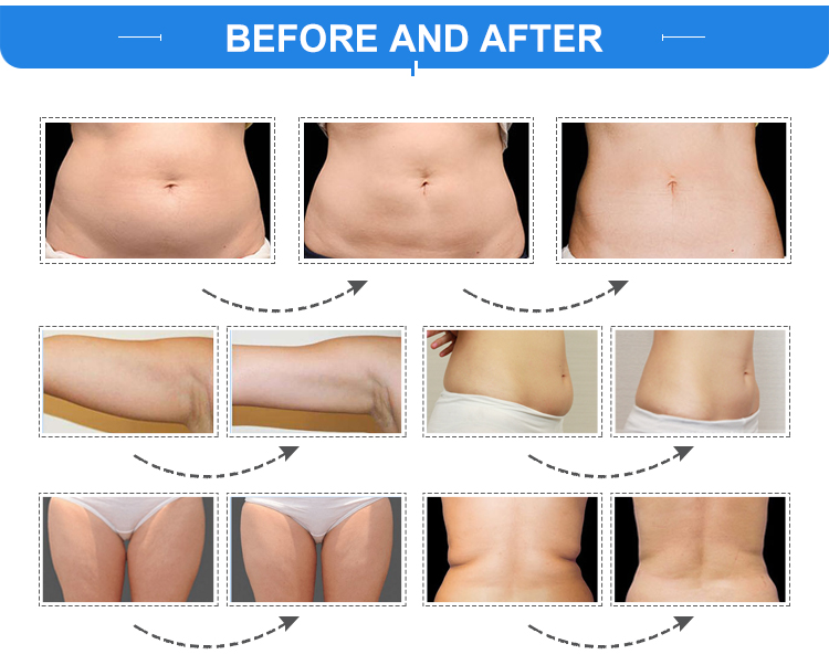 Double Chin Weight Loss Cryolipolysis Slimming Machine for Fat Freezing