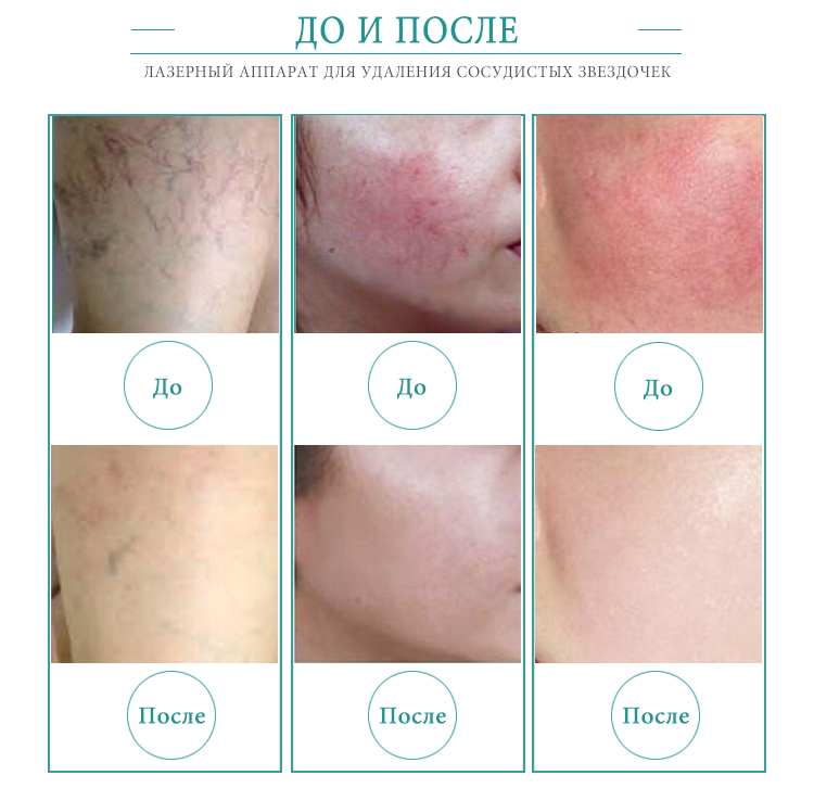 Машина Удаления Лазера HCBEAUTY 980nm Портативная Васкулярная Для Продажи