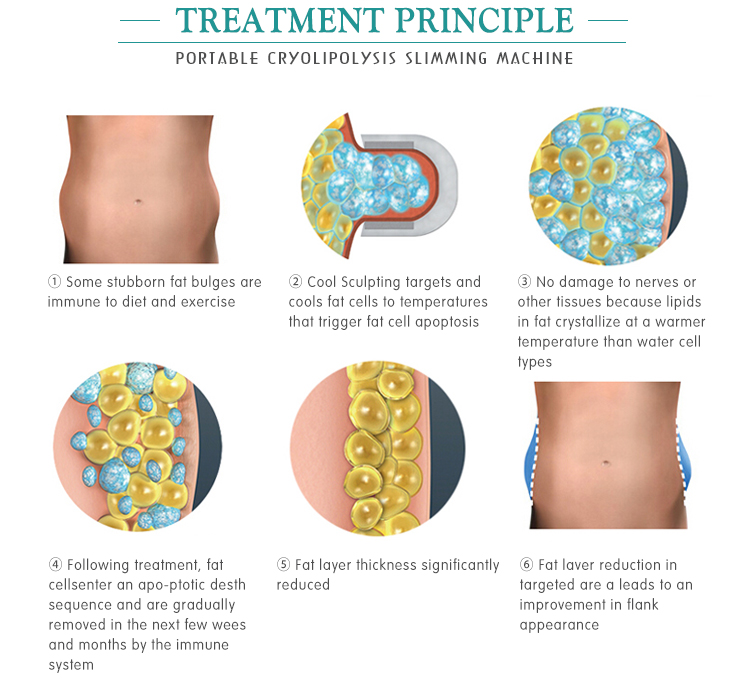 Cheap Price Weight Loss Portable Cryo Slimming Machine To Buy